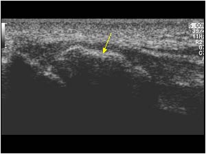 Large calcifications in the tendon longitudinal