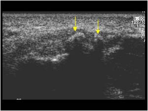 Large calcifications in the tendon transverse