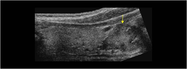 Parathyroid adenoma caudal to the left thyroid lobe longitudinal