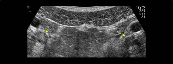 Thrombosis of the iliac veins on both sides