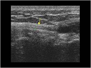 Peroneal nerve and ganglion cyst longitudinal