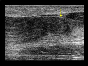 Proximal stump and achilles tendon rupture longitudinal