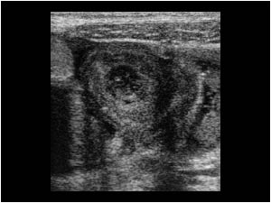 Small bowel wall thickening transverse