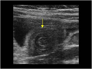 Intermittent small bowel intussusception