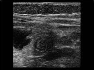 Intermittent small bowel intussusception