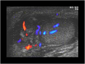 Hypervascularized testicle and epididymis