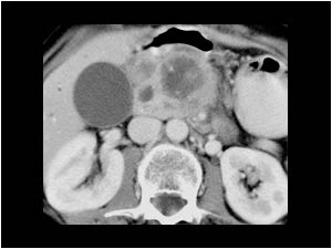 Pancreatic head carcinoma with an inhomogeneous mass