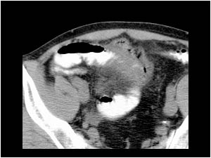 Small bowel inflammation with a thickened wall and a small amount of air in the peritoneal cavity