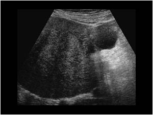 Large solid ovarian mass with a peripheral cystic area