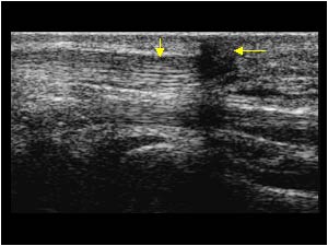 Distal end of the flexor carpi ulnaris tendon with scar tissue longitudinal