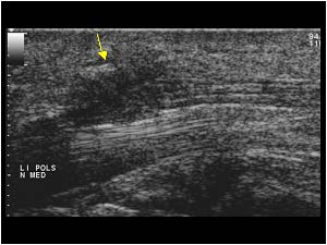 Traumatic lesion of the median nerve with irregular scar tissue longitudinal