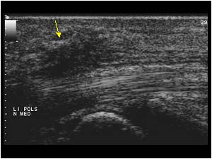 Traumatic lesion of the median nerve with irregular scar tissue longitudinal