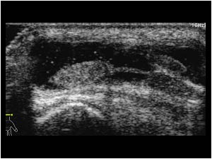 Effusion in the tendon sheath of compartment 2 transverse