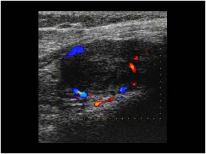 Histiocytic mass transverse with peripheral vascularity