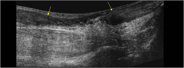 Full thickness achilles tendon rupture with retraction of the tendon ends longitudinal