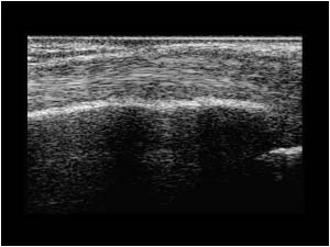 Thickened right proximal posterior tibial tendon longitudinal