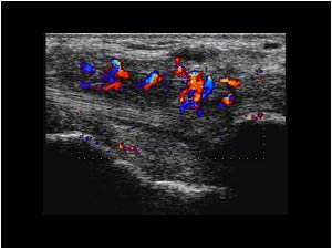 Tendinosis and insertion tendinopathy on the right side with hypervascularity longitudinal
