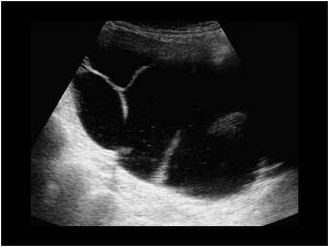 Multiloculated cystic ovarian mass