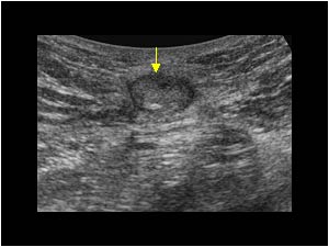 Omphalomesenteric duct remnant transverse