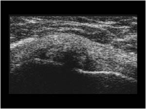 Thickened infraspinatus tendon with calcifications