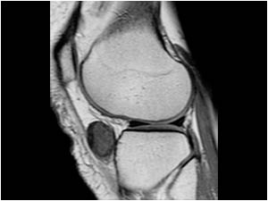 Lateral side knee