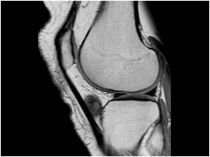 Lateral side knee