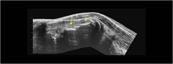 Myositis ossificans with a calcified intramuscular mass extended field of view