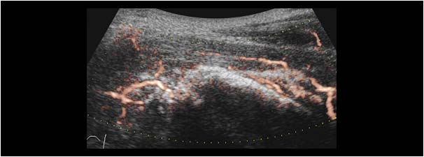 Myositis ossificans with a calcified intramuscular mass with hypervascularity e flow