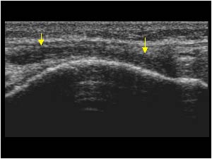 Fluid between the iliotibial band and lateral condyle longitudinal