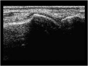 Metatarsophalangeal joint of digit 1 without signs of an arthritis