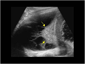 Consolidation and atelectasis of the lower lobe
