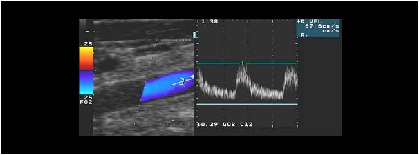 Normal doppler signel proximal to the stenosis