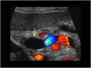 Dilatated common bile duct and patent splenic vein transverse