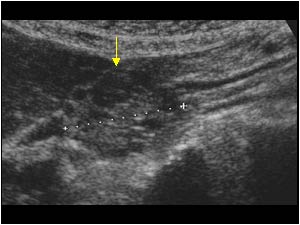 Pancreatic adenocarcinoma with a cystic mass longitudinal