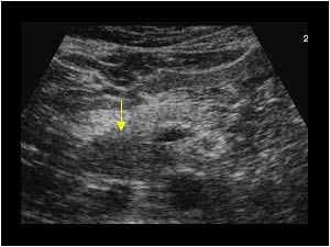 Focal pancreatitis in the pancreatic head with a hypoechoic area in the uncinate proces transverse