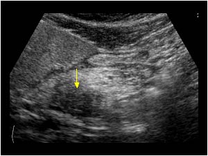 Focal pancreatitis in the pancreatic head with a hypoechoic area in the uncinate proces longitudinal