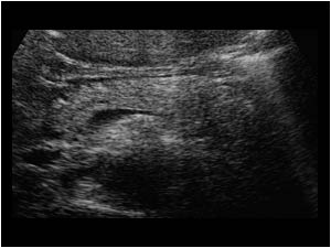 Pancreas with a normal corpus and tail transverse