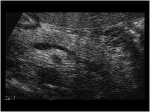 Pancreas with a normal corpus and tail transverse