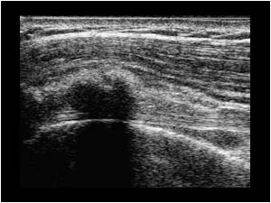 Calcifications in the bursa anterior of the biceps tendon