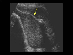 Large rectum carcinoma with a large hypoechoic mass and a narrow hyperechoic lumen (arrow)