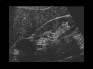 Normal right kidney with a cyst longitudinal