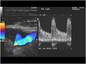 High systolic velocity in the stenosis