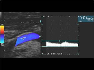 Dampened post obstructive spectral wave form in the internal carotid artery