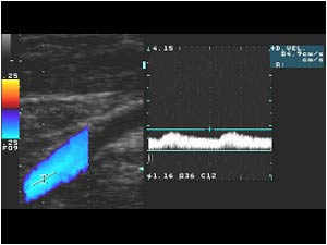 Dampened post obstructive spectral wave form in the external carotid artery