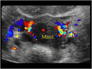 Bilateral obstruction of the ureters and cervix carcinoma transverse