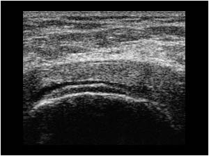 Effusion between the cartilage of the humeral head and the supraspinatus tendon transverse
