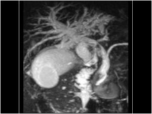 Case of the month July 2005: Various causes of bile duct dilatation