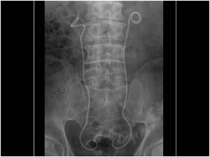 Plain abdominal X ray showing a stent in the right and left ureter
