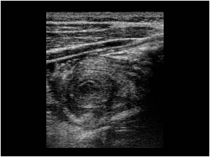 Thickened appendix that mimics an intussusception transverse