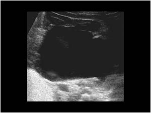 Ureteropelvic junction stenosis with a dilatated left kidney transverse